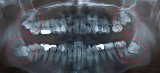 Nhổ răng số 8 - Có nên nhổ bỏ hay giữ lại, vì sao? 2