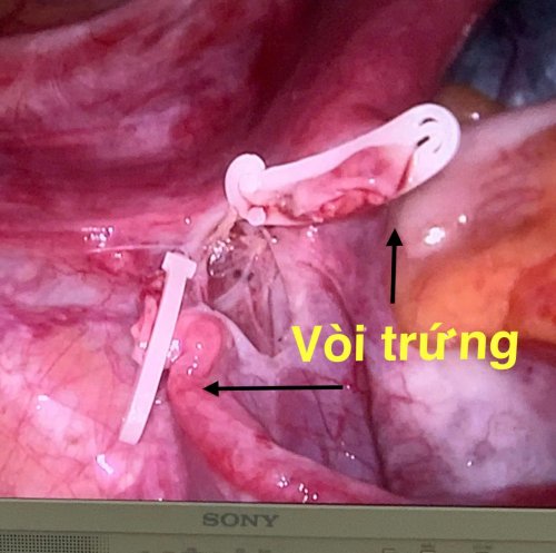 vòi trứng.jpg